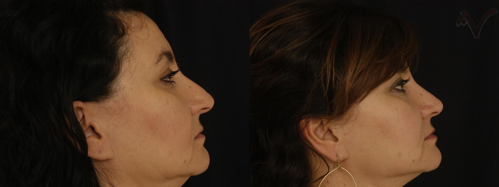 Before & After Rhinoplasty Case 85 Right Side View in Los Angeles, CA