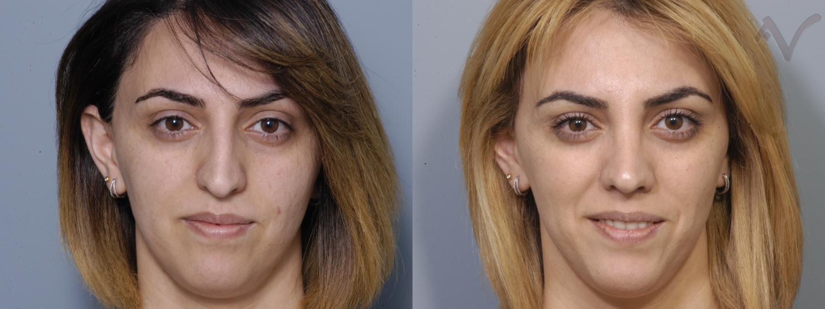 Before & After Rhinoplasty Case 86 Front View in Burbank, CA