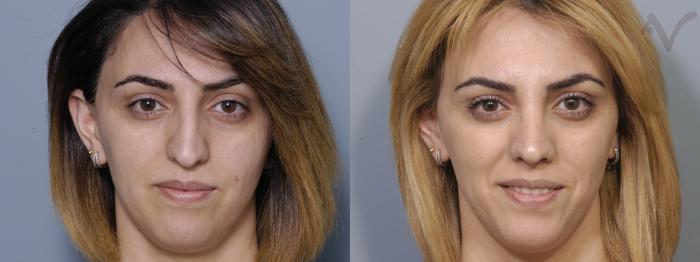 Before & After Rhinoplasty Case 86 Front View in Los Angeles, CA