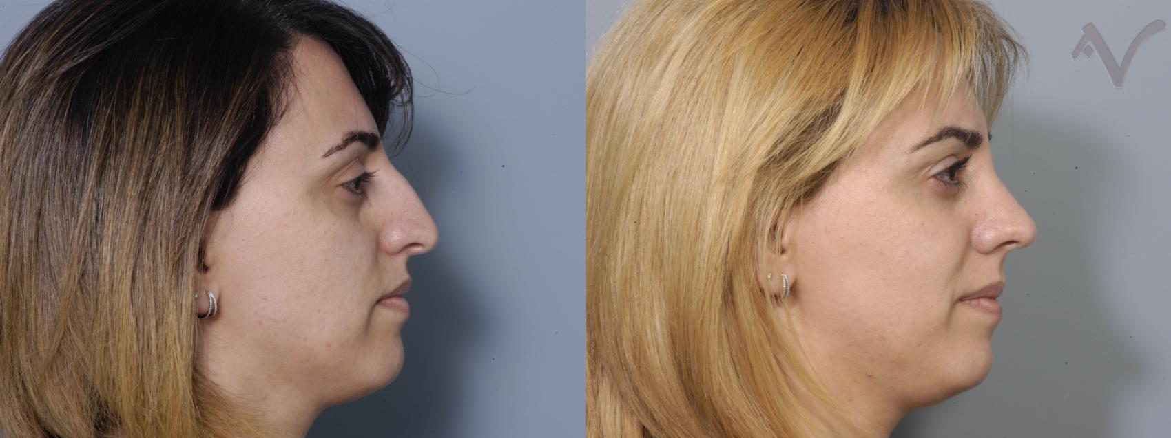 Before & After Rhinoplasty Case 86 Right Side View in Burbank, CA
