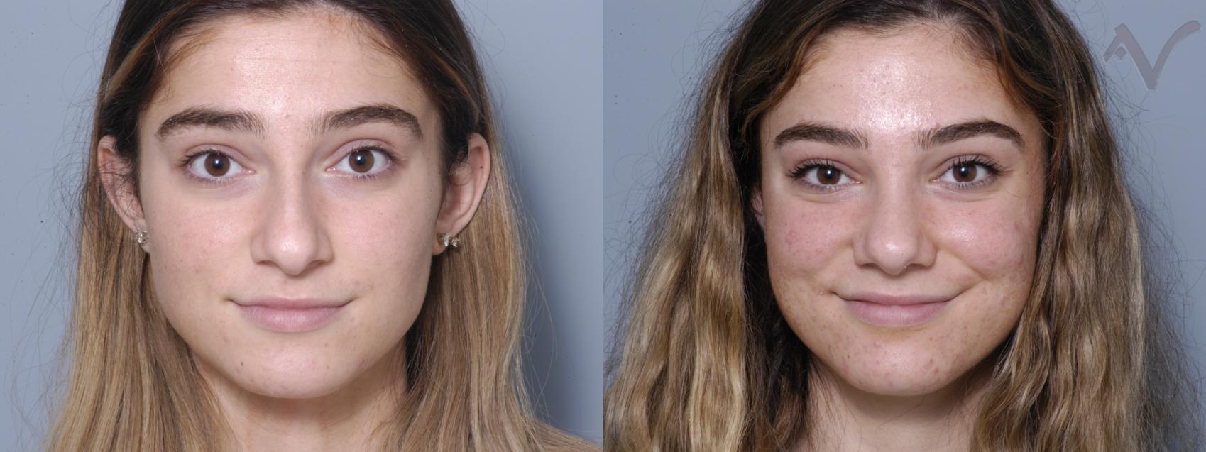 Before & After Rhinoplasty Case 87 Front View in Los Angeles, CA