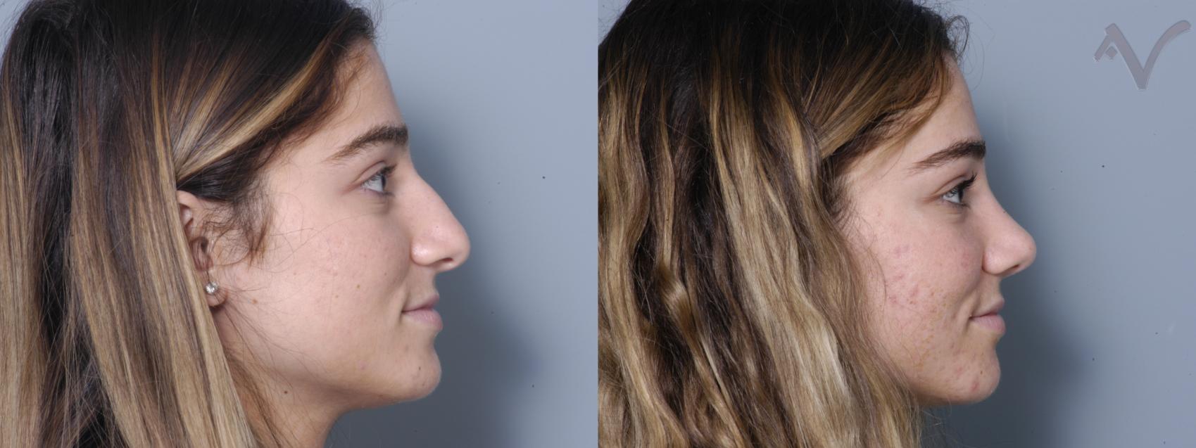 Before & After Rhinoplasty Case 87 Right Side View in Los Angeles, CA