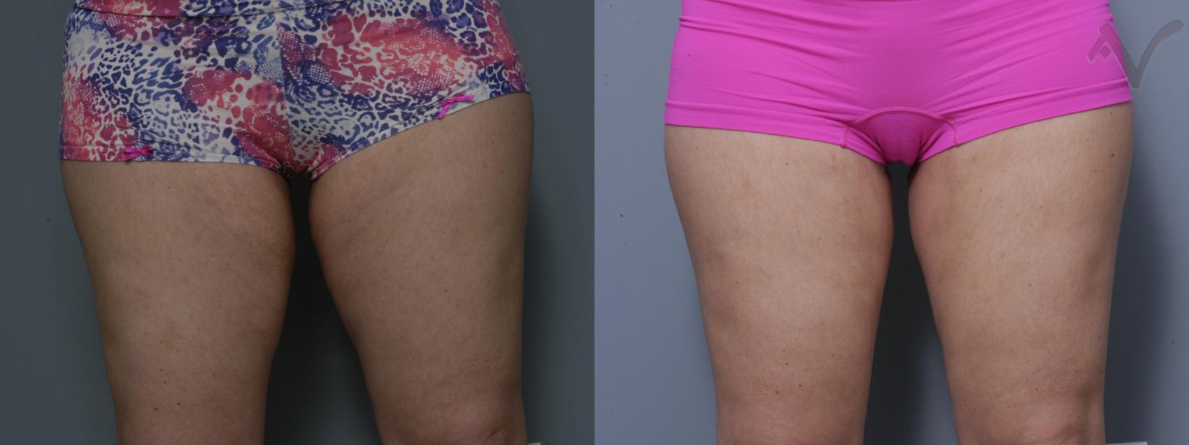 Before & After Thigh Lift Case 13 Front View in Los Angeles, CA