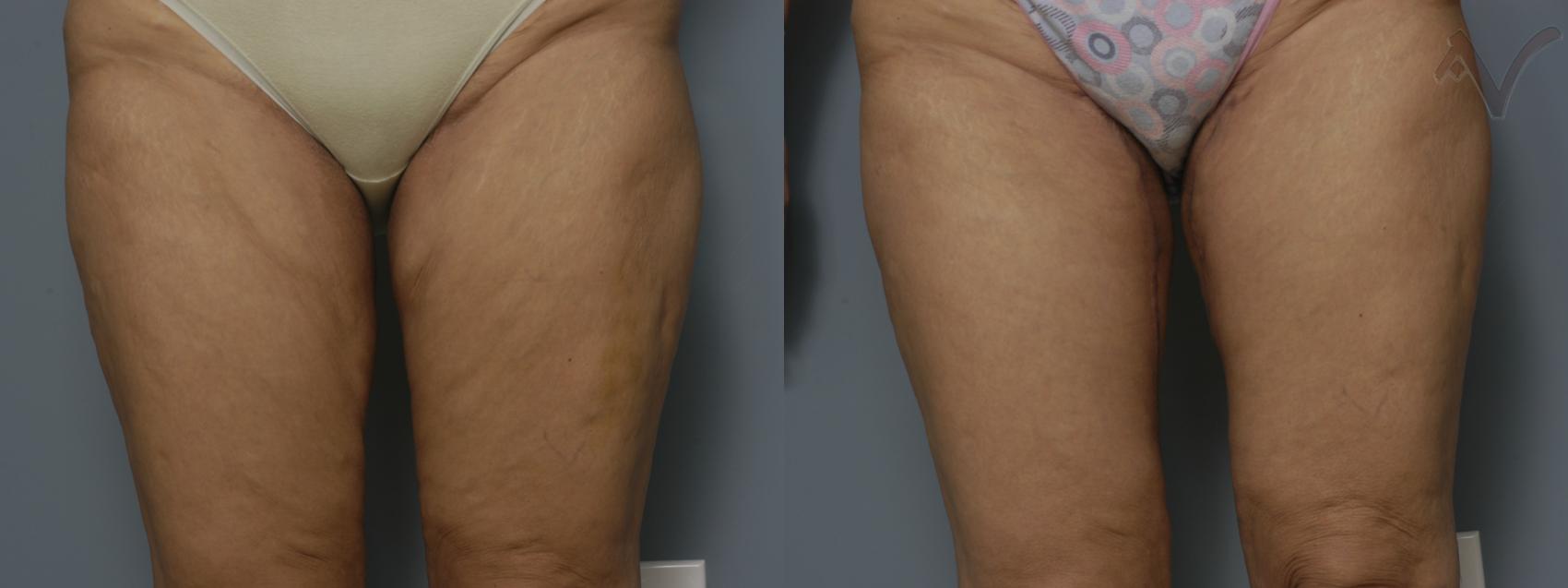 Before & After Thigh Lift Case 14 Front View in Los Angeles, CA