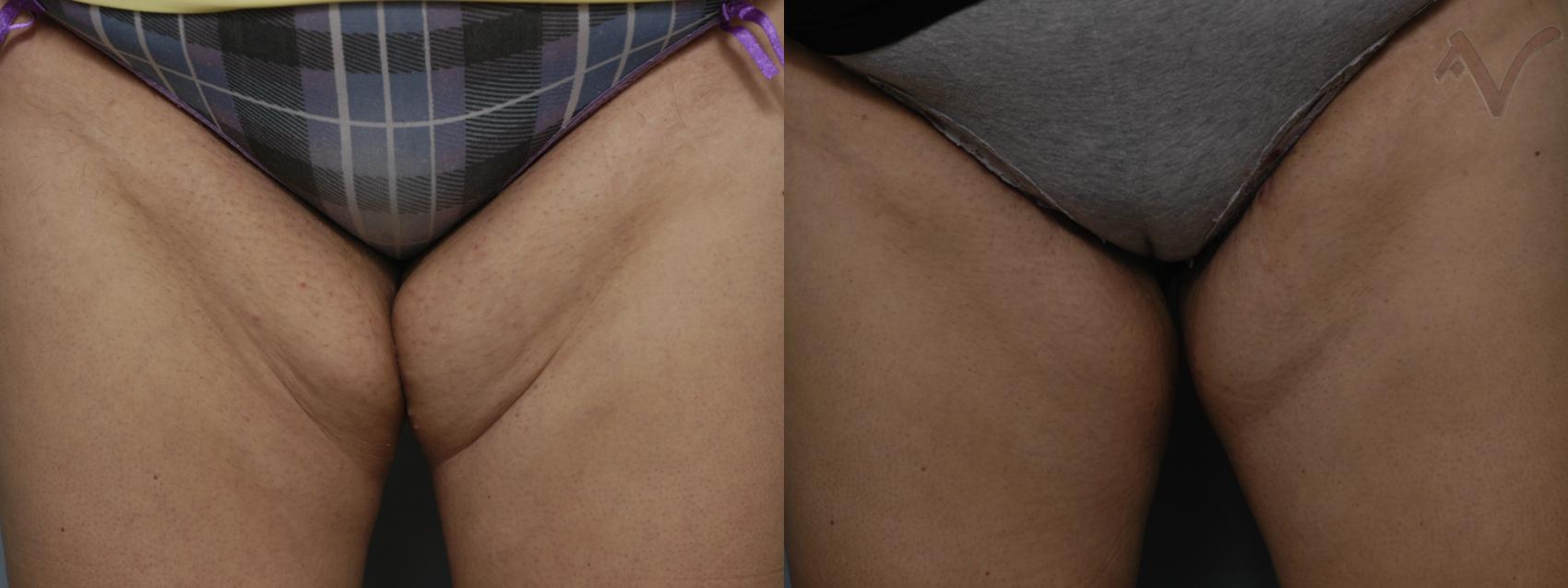 Before & After Thigh Lift Case 15 Front View in Los Angeles, CA