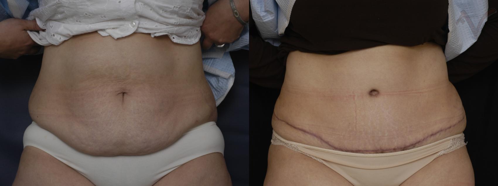 Before & After Tummy Tuck Case 182 Front View in Los Angeles, CA