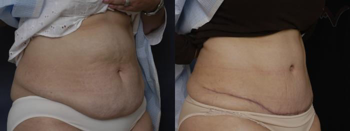 Before & After Tummy Tuck Case 182 Right Oblique View in Los Angeles, CA