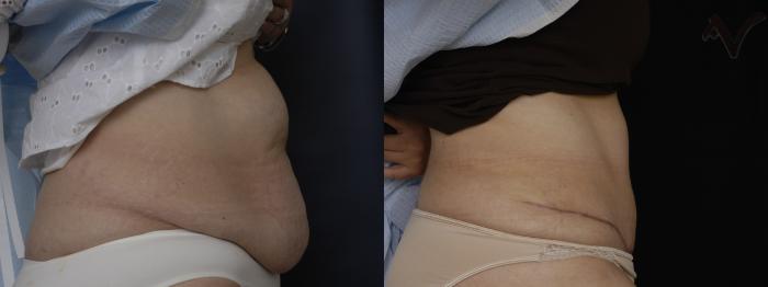 Before & After Tummy Tuck Case 182 Right Side View in Los Angeles, CA