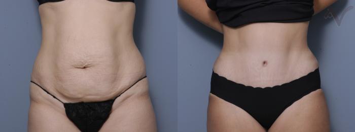 Before & After Tummy Tuck Case 183 Front View in Los Angeles, CA