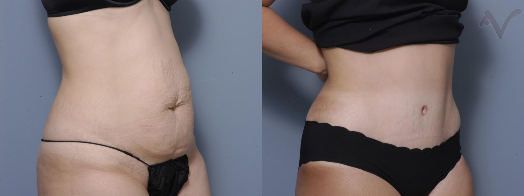 Before & After Tummy Tuck Case 183 Right Oblique View in Los Angeles, CA