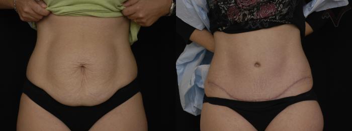 Before & After Tummy Tuck Case 184 Front View in Los Angeles, CA