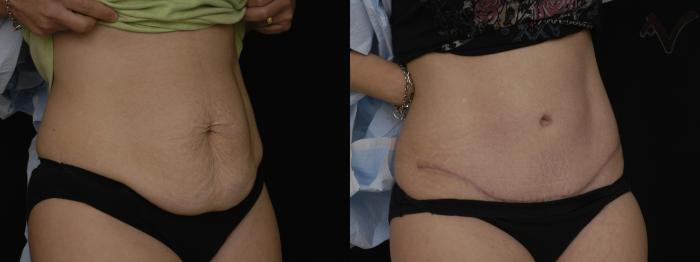 Before & After Tummy Tuck Case 184 Right Oblique View in Los Angeles, CA