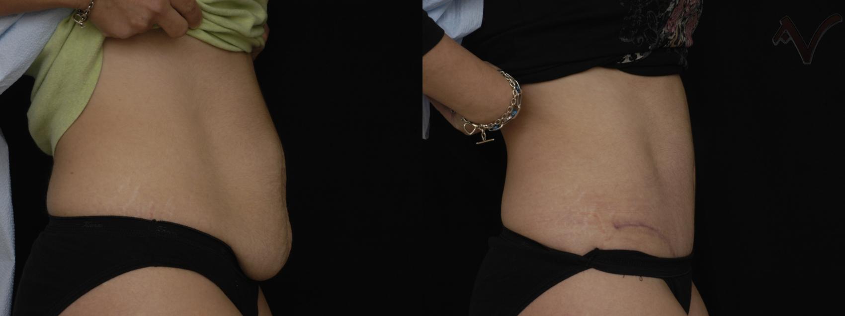 Before & After Tummy Tuck Case 184 Right Side View in Los Angeles, CA