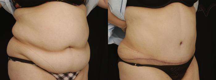 Before & After Tummy Tuck Case 186 Right Oblique View in Los Angeles, CA