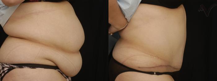 Before & After Tummy Tuck Case 186 Right Side View in Los Angeles, CA