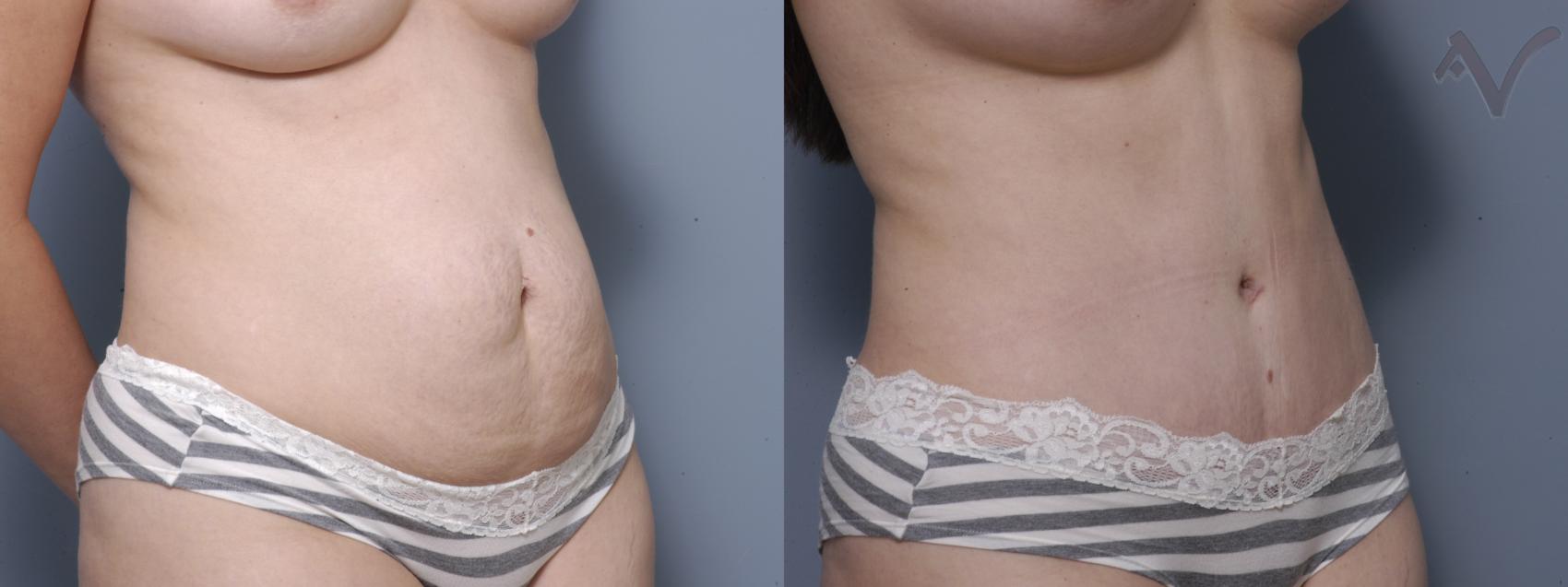 Before & After Tummy Tuck Case 191 Right Oblique View in Los Angeles, CA