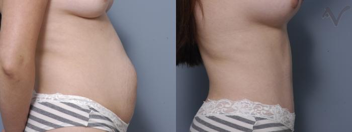 Before & After Tummy Tuck Case 191 Right Side View in Los Angeles, CA