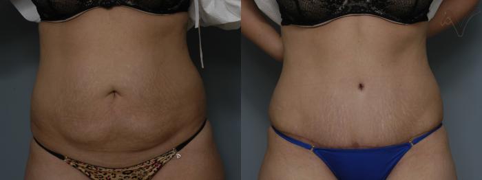 Before & After Tummy Tuck Case 192 Front View in Los Angeles, CA