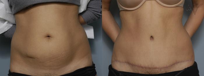 Before & After Tummy Tuck Case 193 Front View in Los Angeles, CA