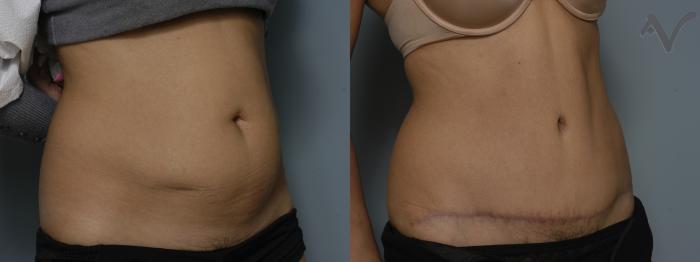 Before & After Tummy Tuck Case 193 Right Oblique View in Los Angeles, CA