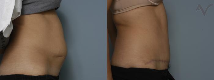 Before & After Tummy Tuck Case 193 Right Side View in Los Angeles, CA