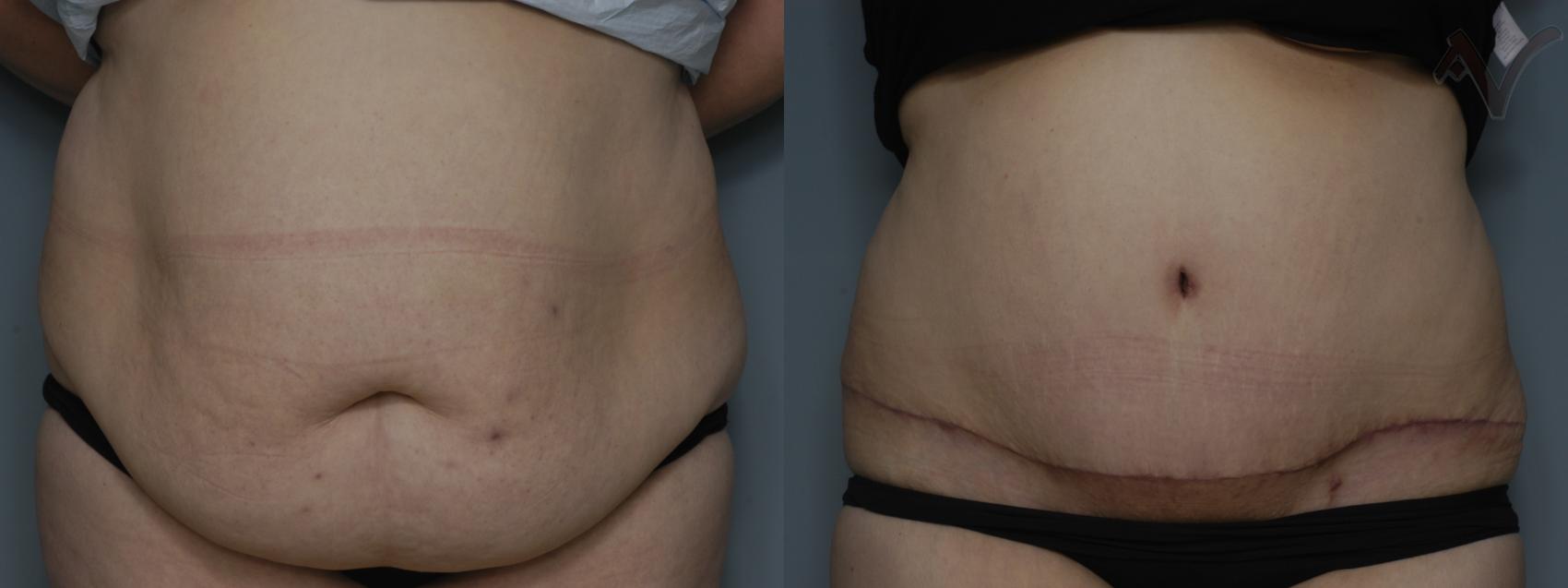 Before & After Tummy Tuck Case 195 Front View in Los Angeles, CA