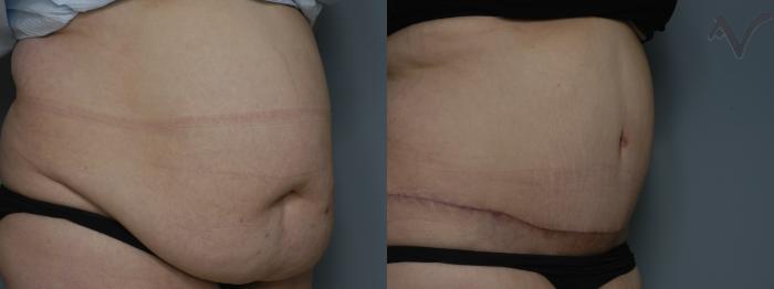 Before & After Tummy Tuck Case 195 Right Oblique View in Los Angeles, CA