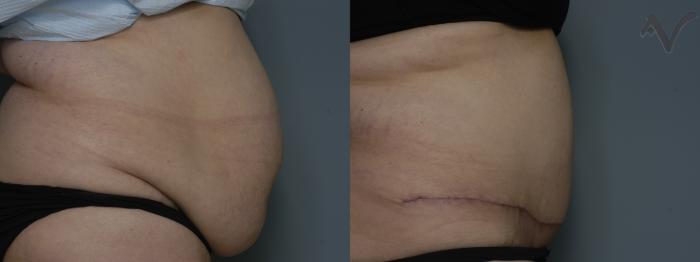 Before & After Tummy Tuck Case 195 Right Side View in Los Angeles, CA