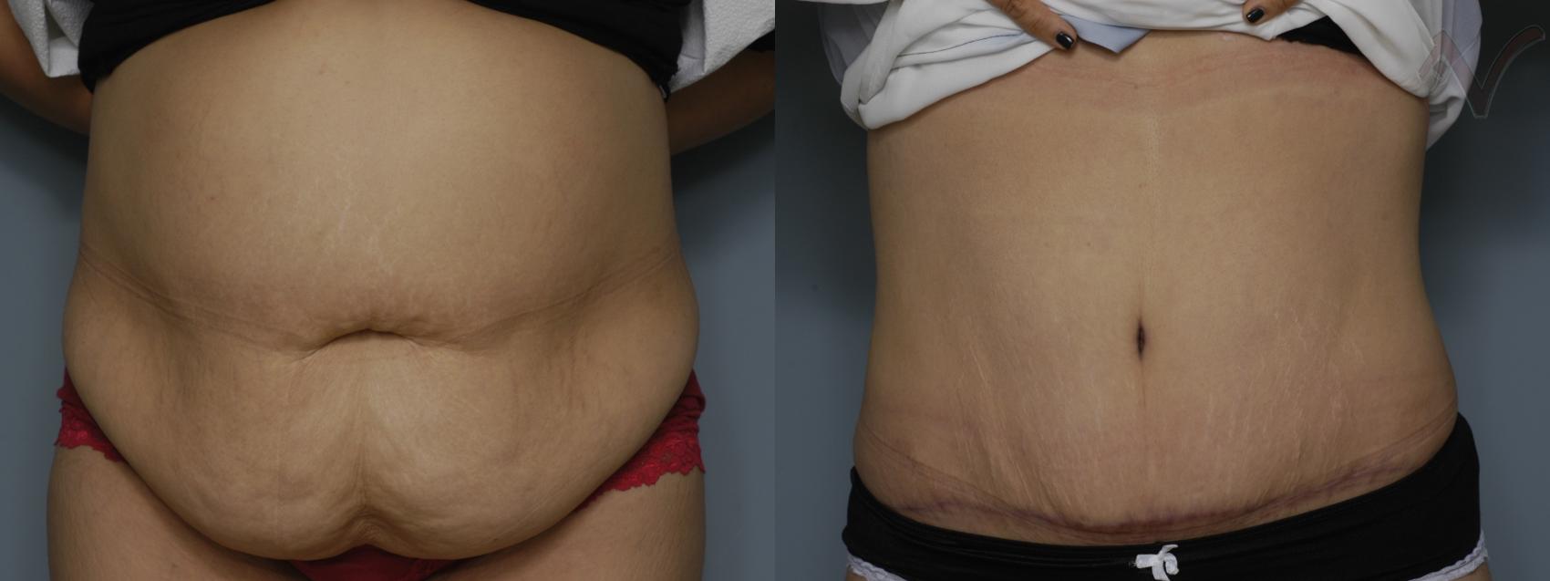 Before & After Tummy Tuck Case 197 Front View in Los Angeles, CA