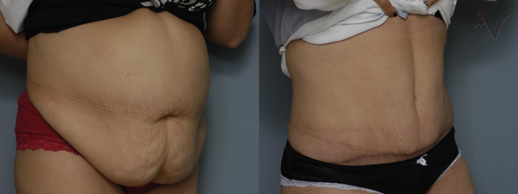 Before & After Tummy Tuck Case 197 Right Oblique View in Los Angeles, CA