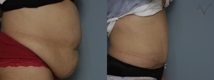 Before & After Tummy Tuck Case 197 Right Side View in Los Angeles, CA