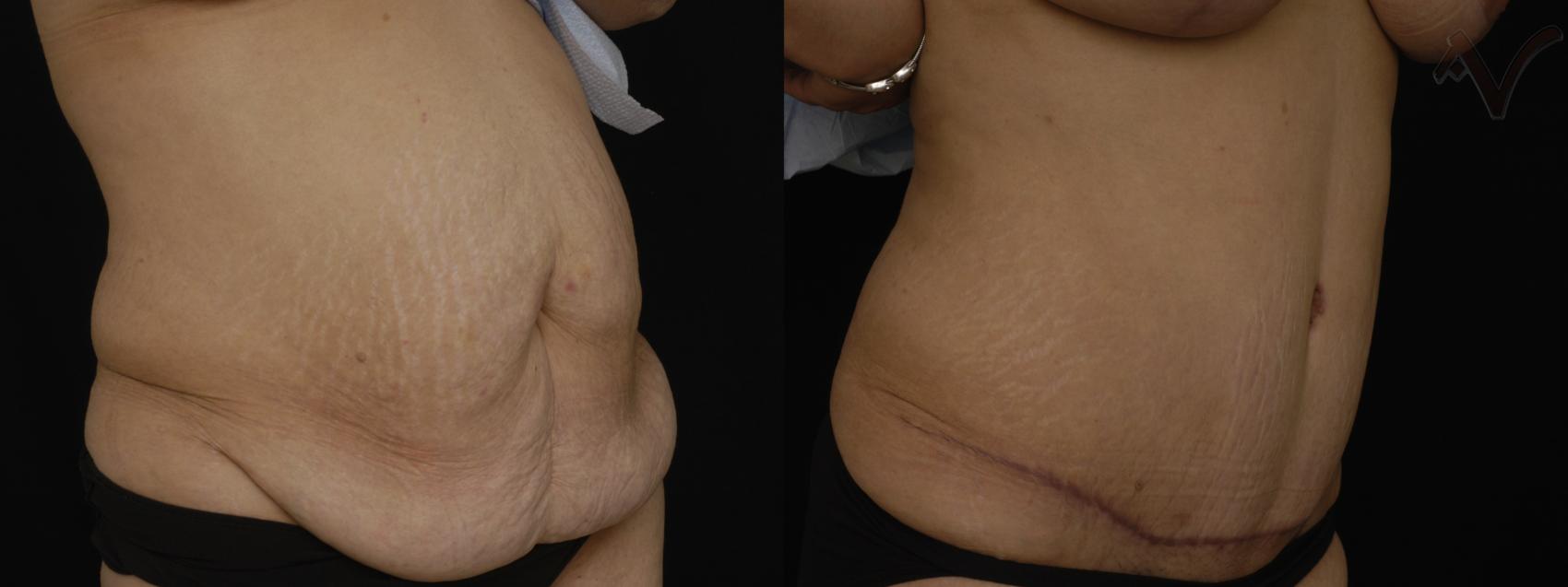 Before & After Tummy Tuck Case 201 Right Oblique View in Los Angeles, CA