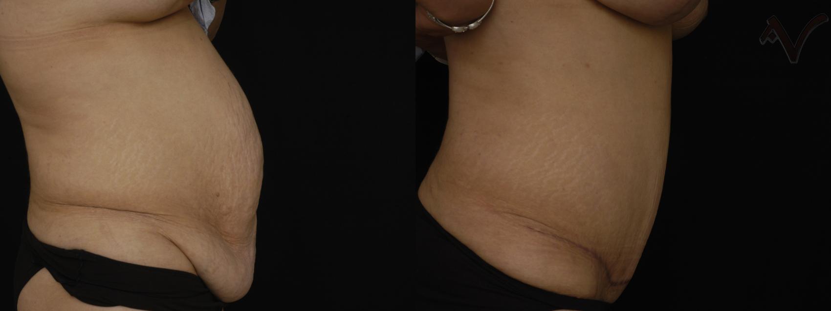 Before & After Tummy Tuck Case 201 Right Side View in Los Angeles, CA