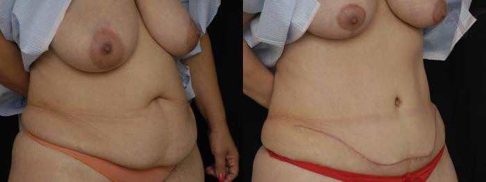 Before & After Tummy Tuck Case 202 Right Oblique View in Los Angeles, CA