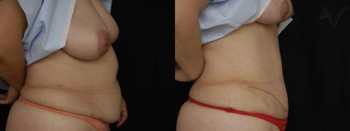 Before & After Tummy Tuck Case 202 Right Side View in Los Angeles, CA