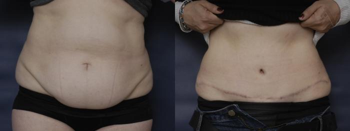 Before & After Tummy Tuck Case 203 Front View in Los Angeles, CA