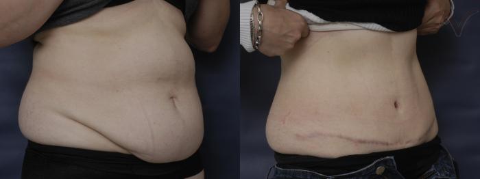 Before & After Tummy Tuck Case 203 Right Oblique View in Los Angeles, CA