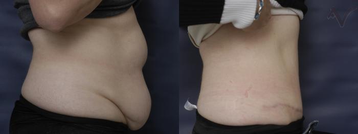 Before & After Tummy Tuck Case 203 Right Side View in Los Angeles, CA