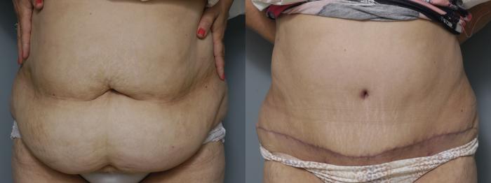 Before & After Tummy Tuck Case 205 Front View in Los Angeles, CA