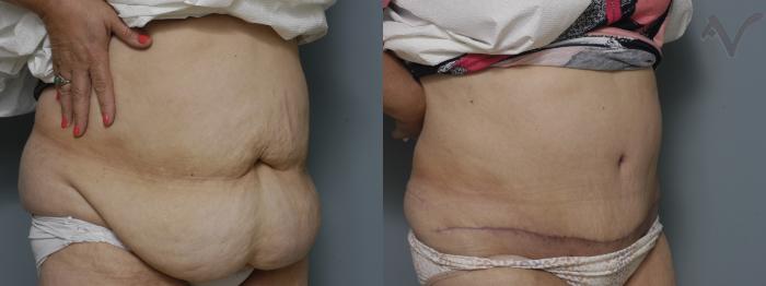 Before & After Tummy Tuck Case 205 Right Oblique View in Los Angeles, CA