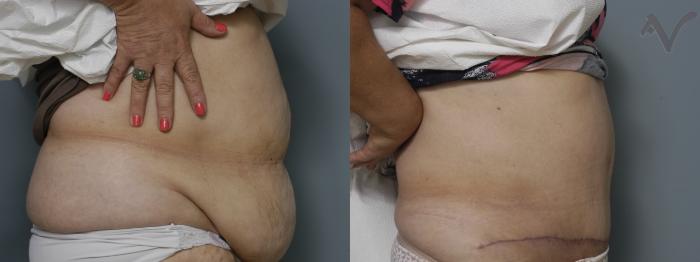 Before & After Tummy Tuck Case 205 Right Side View in Los Angeles, CA