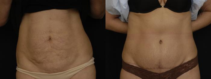 Before & After Tummy Tuck Case 206 Front View in Los Angeles, CA