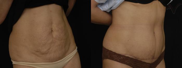 Before & After Tummy Tuck Case 206 Right Oblique View in Los Angeles, CA