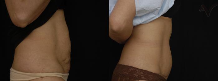 Before & After Tummy Tuck Case 206 Right Side View in Los Angeles, CA
