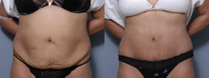 Before & After Tummy Tuck Case 207 Front View in Los Angeles, CA