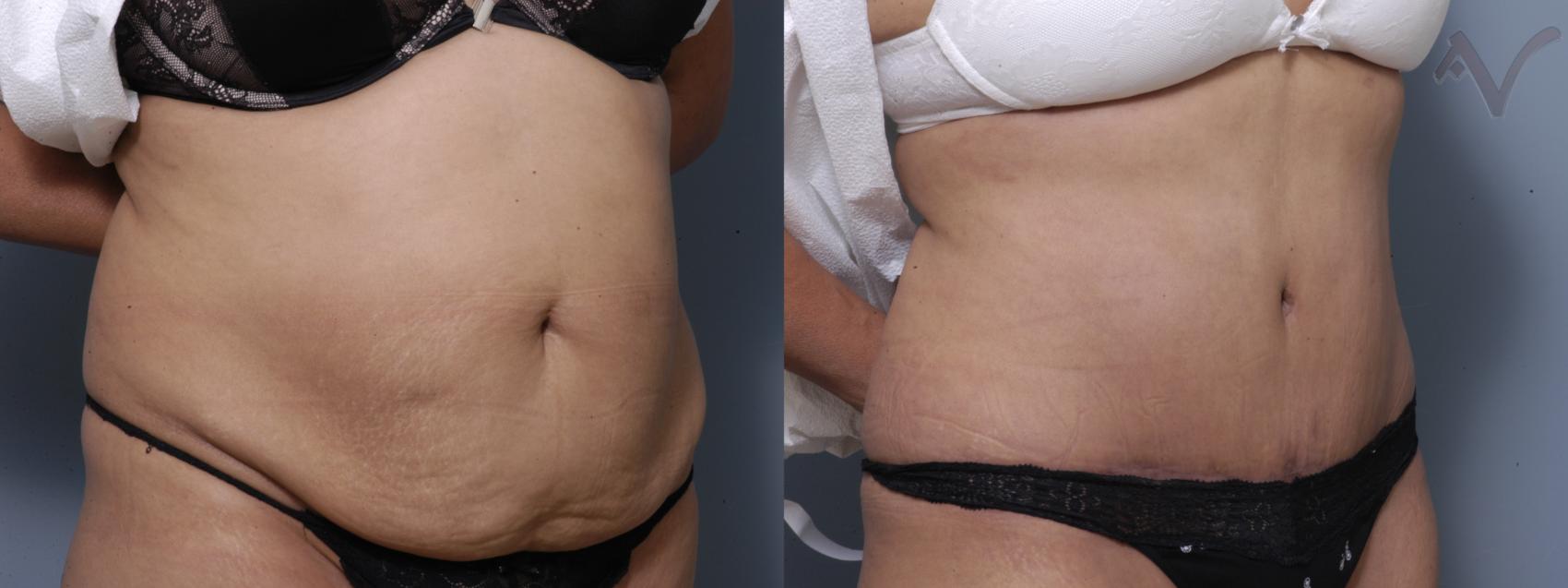 Before & After Tummy Tuck Case 207 Right Oblique View in Los Angeles, CA