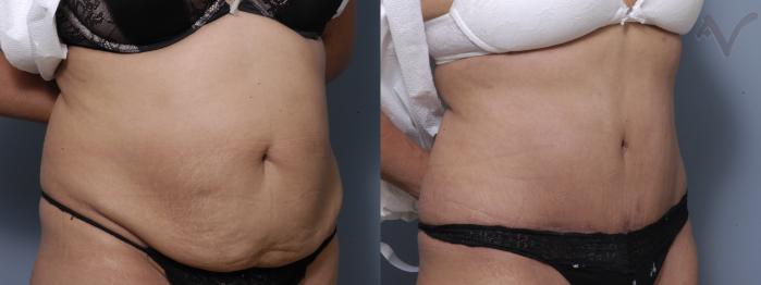 Before & After Tummy Tuck Case 207 Right Oblique View in Los Angeles, CA