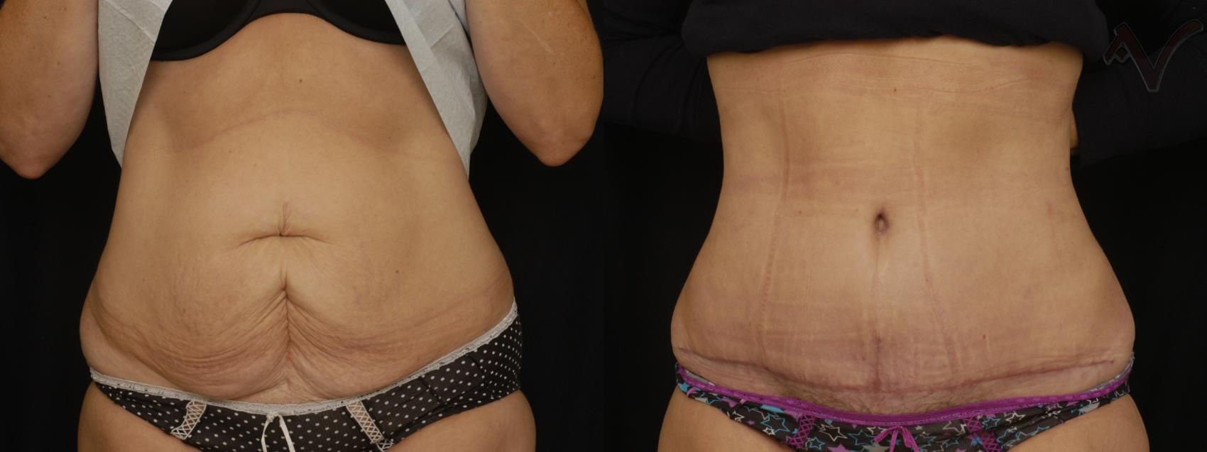 Before & After Tummy Tuck Case 210 Front View in Los Angeles, CA