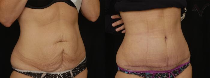Before & After Tummy Tuck Case 210 Right Oblique View in Los Angeles, CA