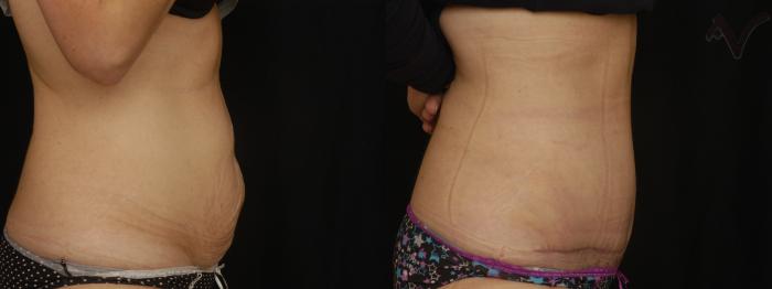 Before & After Tummy Tuck Case 210 Right Side View in Los Angeles, CA